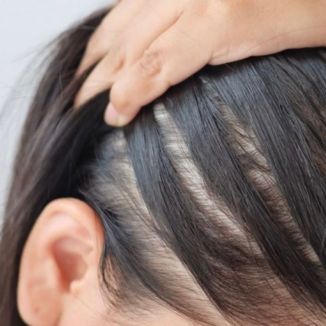 Alopecia